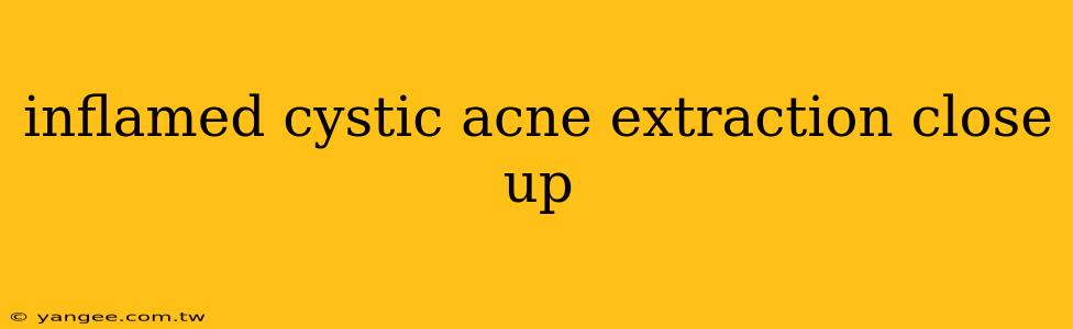 inflamed cystic acne extraction close up